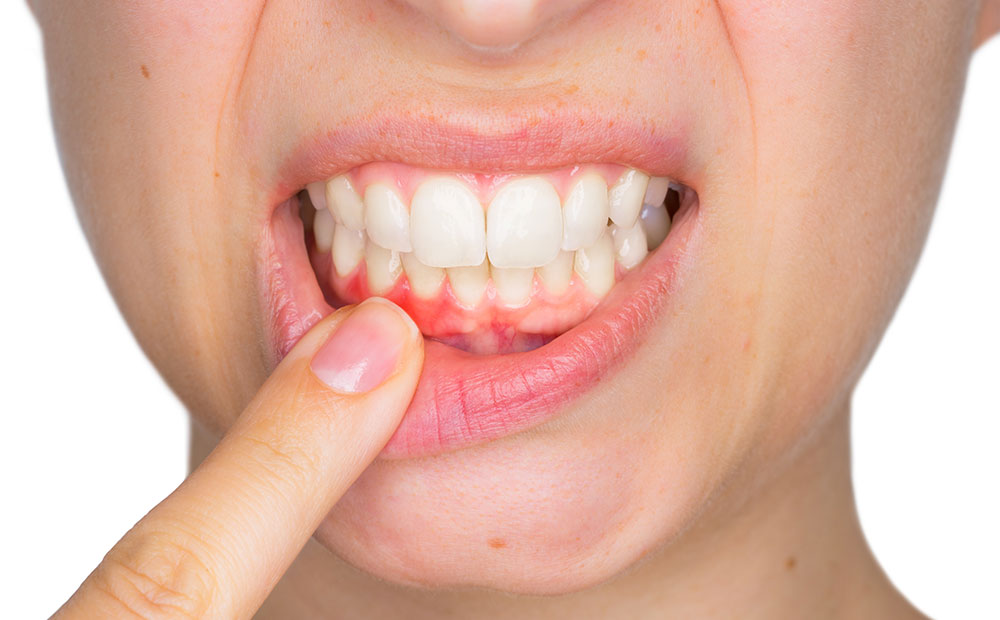 歯周病は細菌が引き起こす感染症です