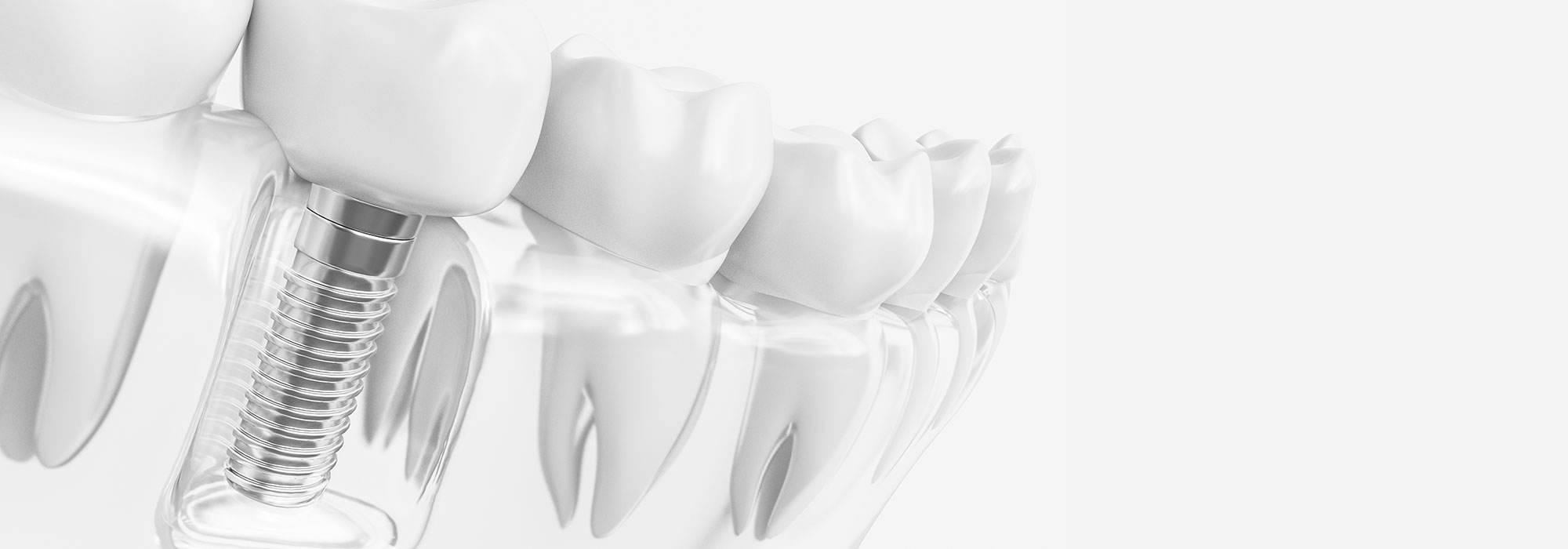 「第2の永久歯」として機能するインプラント